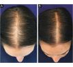 ALOPEXY 2% minoxidil pre ženy 3 x 60 ml