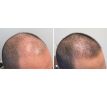 ALOPEXY 5% minoxidil pre mužov 3 x 60 ml